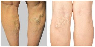 Varices dans les Jambes